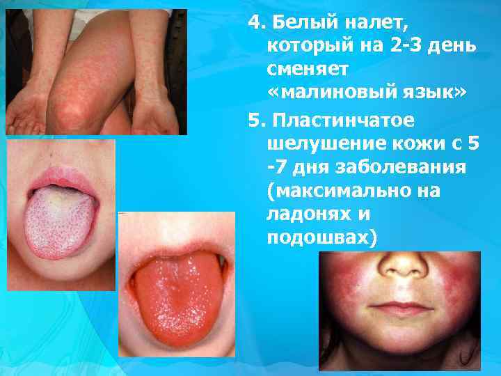 4. Белый налет, который на 2 -3 день сменяет «малиновый язык» 5. Пластинчатое шелушение