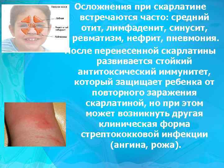 Осложнения при скарлатине встречаются часто: средний отит, лимфаденит, синусит, ревматизм, нефрит, пневмония. После перенесенной