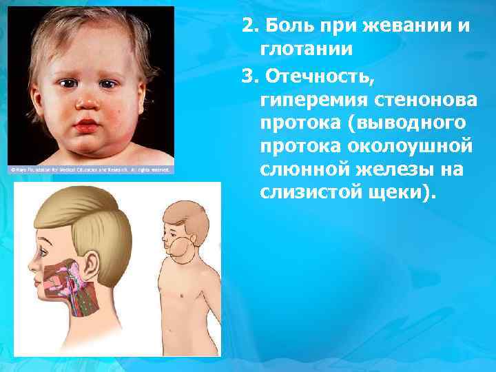 2. Боль при жевании и глотании 3. Отечность, гиперемия стенонова протока (выводного протока околоушной