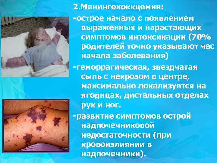 2. Менингококкцемия: -острое начало с появлением выраженных и нарастающих симптомов интоксикации (70% родителей точно