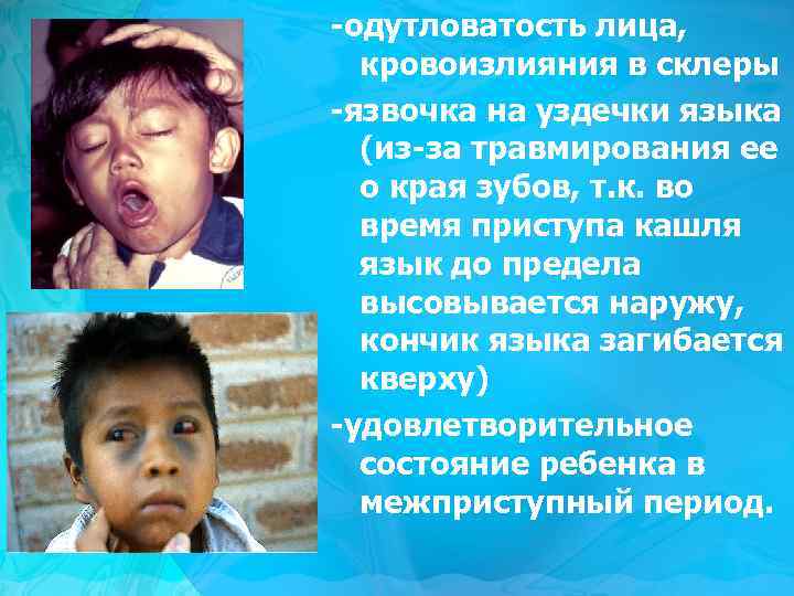 -одутловатость лица, кровоизлияния в склеры -язвочка на уздечки языка (из-за травмирования ее о края