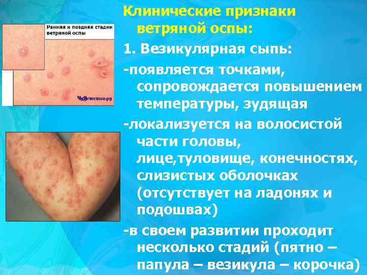 Клинические признаки ветряной оспы: 1. Везикулярная сыпь: -появляется точками, сопровождается повышением температуры, зудящая -локализуется