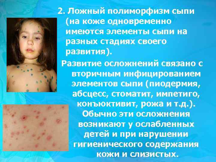 2. Ложный полиморфизм сыпи (на коже одновременно имеются элементы сыпи на разных стадиях своего
