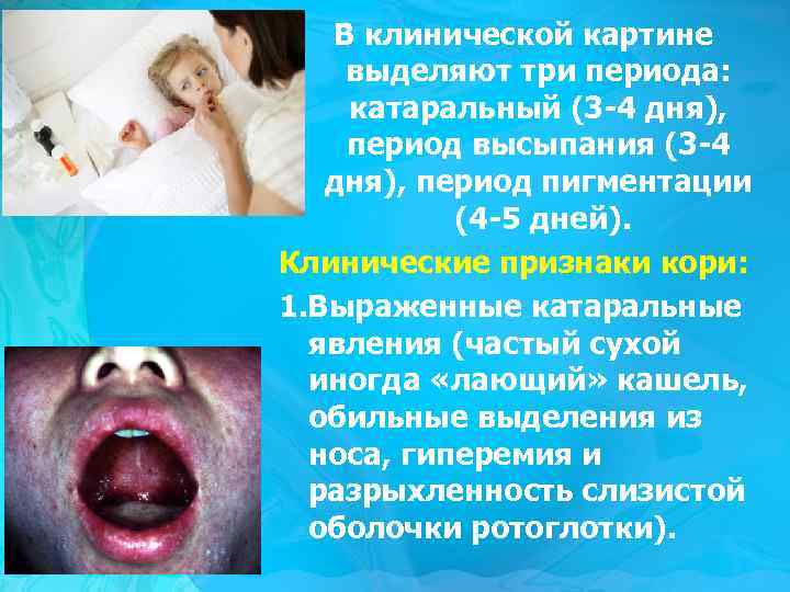 В клинической картине выделяют три периода: катаральный (3 -4 дня), период высыпания (3 -4