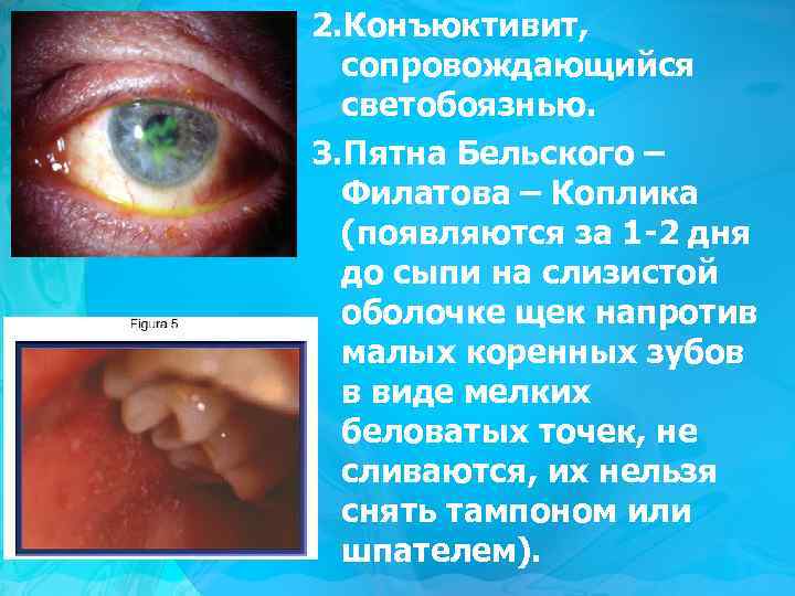 2. Конъюктивит, сопровождающийся светобоязнью. 3. Пятна Бельского – Филатова – Коплика (появляются за 1
