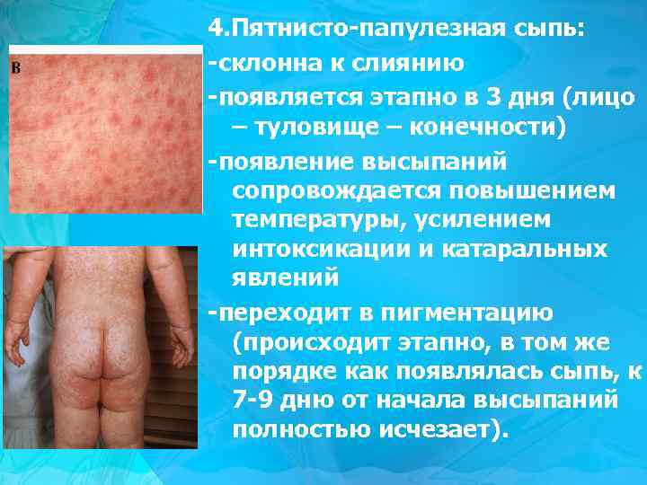 4. Пятнисто-папулезная сыпь: -склонна к слиянию -появляется этапно в 3 дня (лицо – туловище