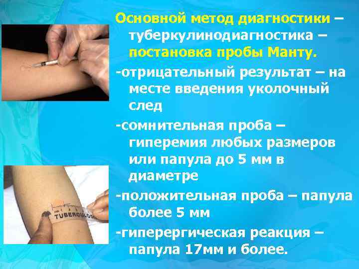 Основной метод диагностики – туберкулинодиагностика – постановка пробы Манту. -отрицательный результат – на месте