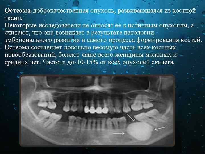 Остеома доброкачественная опухоль, развивающаяся из костной ткани. Некоторые исследователи не относят ее к истинным