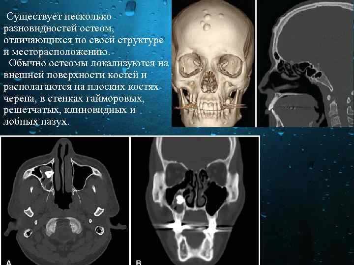  Существует несколько разновидностей остеом, отличающихся по своей структуре и месторасположению. Обычно остеомы локализуются