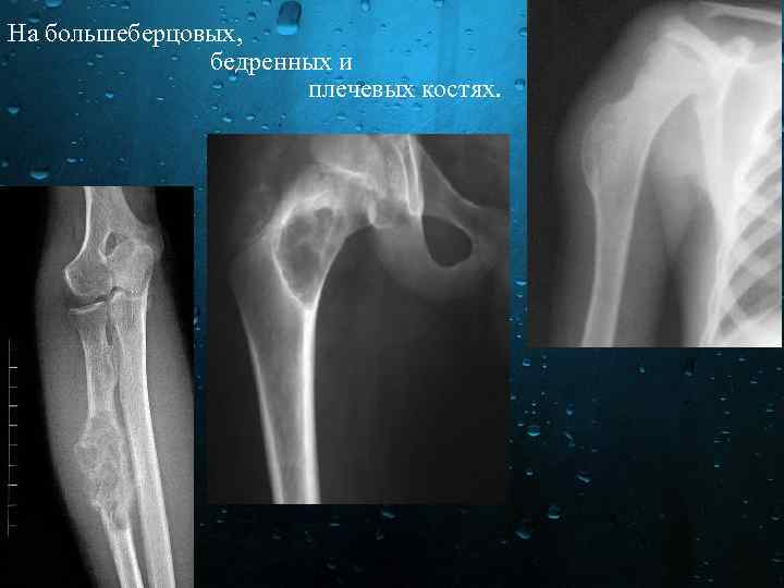 На большеберцовых, бедренных и плечевых костях. 