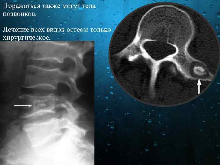 Поражаться также могут тела позвонков. Лечение всех видов остеом только хирургическое. 