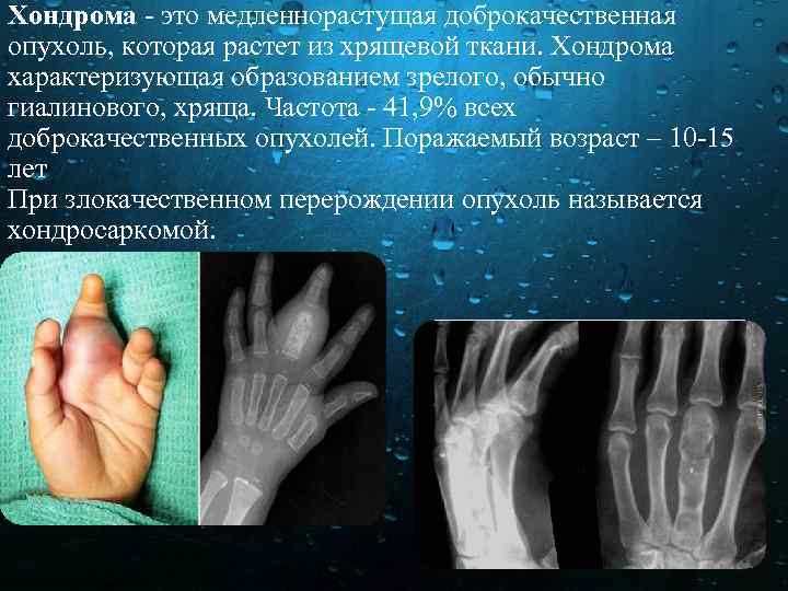 Хондрома это медленнорастущая доброкачественная опухоль, которая растет из хрящевой ткани. Хондрома характеризующая образованием зрелого,