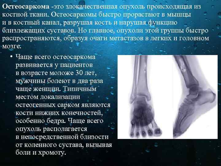 Остеосаркома это злокачественная опухоль происходящая из костной ткани. Остеосаркомы быстро прорастают в мышцы и