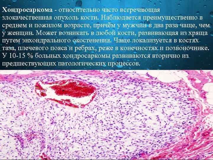 Хондросаркома относительно часто встречающая злокачественная опухоль кости. Наблюдается преимущественно в среднем и пожилом возрасте,