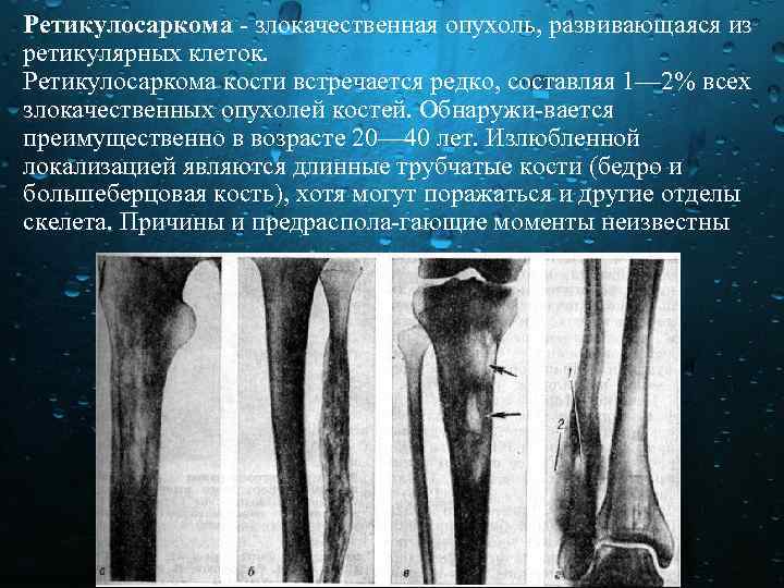Ретикулосаркома злокачественная опухоль, развивающаяся из ретикулярных клеток. Ретикулосаркома кости встречается редко, составляя 1— 2%