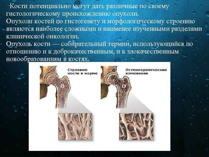 Кости потенциально могут дать различные по своему гистологическому происхождению опухоли. Опухоли костей по