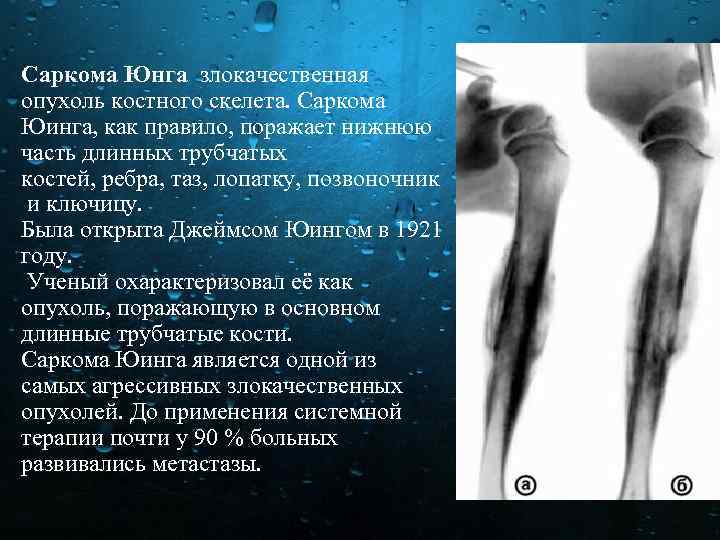 Саркома Юнга злокачественная опухоль костного скелета. Саркома Юинга, как правило, поражает нижнюю часть длинных