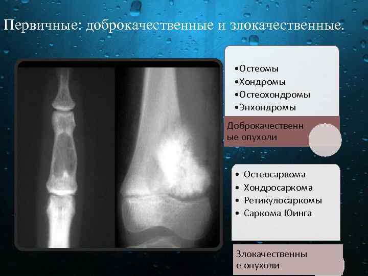 Первичные: доброкачественные и злокачественные. • Остеомы • Хондромы • Остеохондромы • Энхондромы Доброкачественн ые