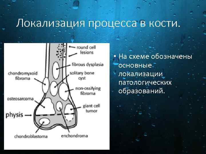 Опухоли костей схема