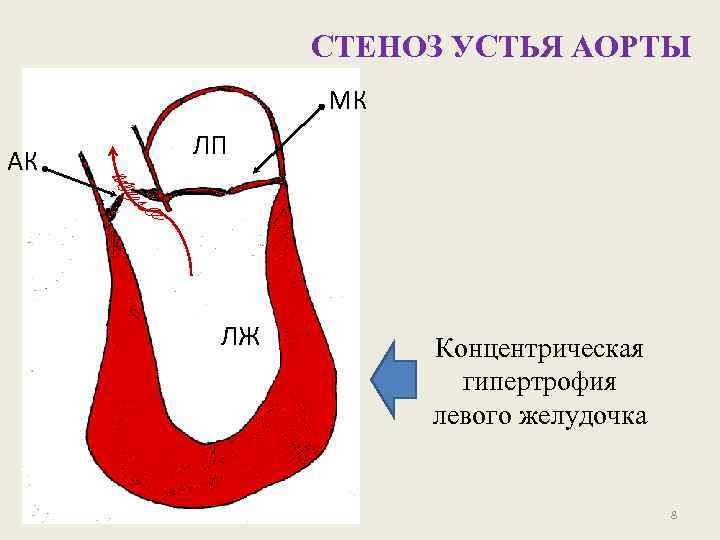 Аортальный стеноз рисунок