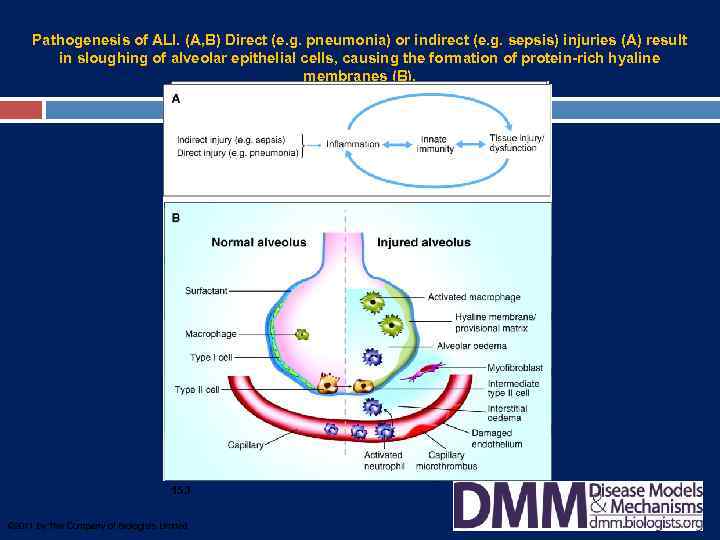 Pathogenesis of ALI. (A, B) Direct (e. g. pneumonia) or indirect (e. g. sepsis)