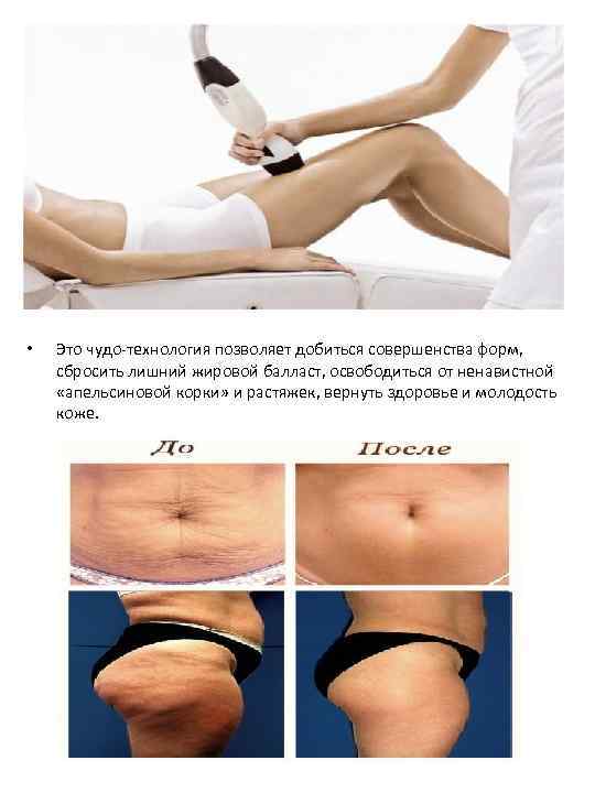  • Это чудо-технология позволяет добиться совершенства форм, сбросить лишний жировой балласт, освободиться от
