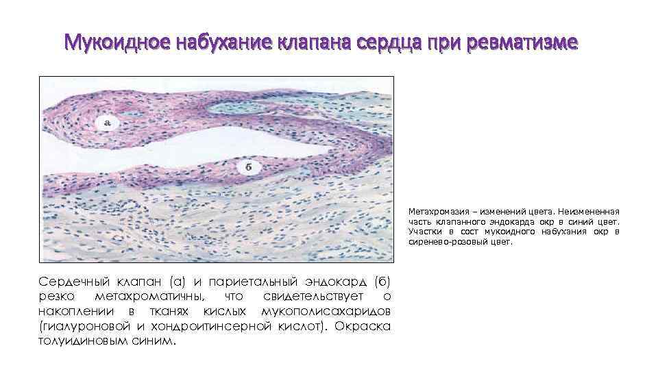 Мукоидное набухание клапана сердца при ревматизме Метахромазия – изменений цвета. Неизмененная часть клапанного эндокарда