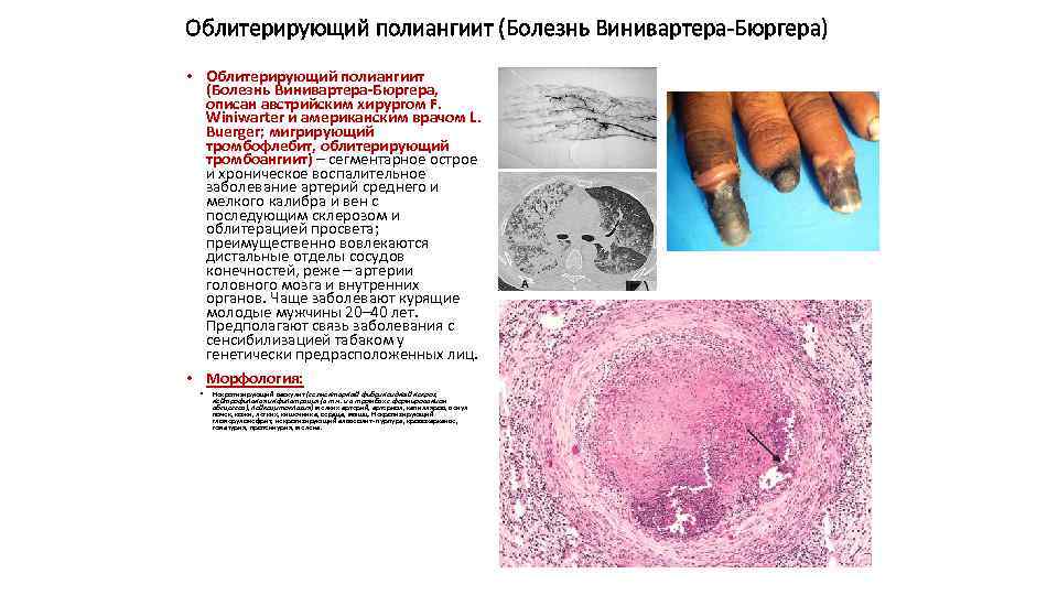 Облитерирующий полиангиит (Болезнь Винивартера-Бюргера) • Облитерирующий полиангиит (Болезнь Винивартера-Бюргера, описан австрийским хирургом F. Winiwarter