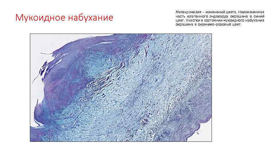 Мукоидное набухание Метахромазия – изменений цвета. Неизмененная часть клапанного эндокарда окрашена в синий цвет.