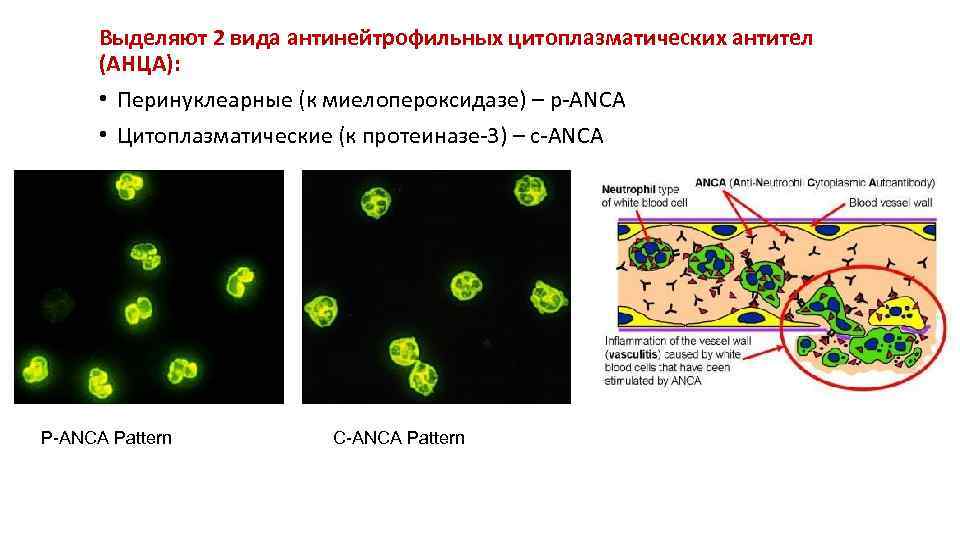 Выделяют 2 вида антинейтрофильных цитоплазматических антител (АНЦА): • Перинуклеарные (к миелопероксидазе) – p-ANCA •