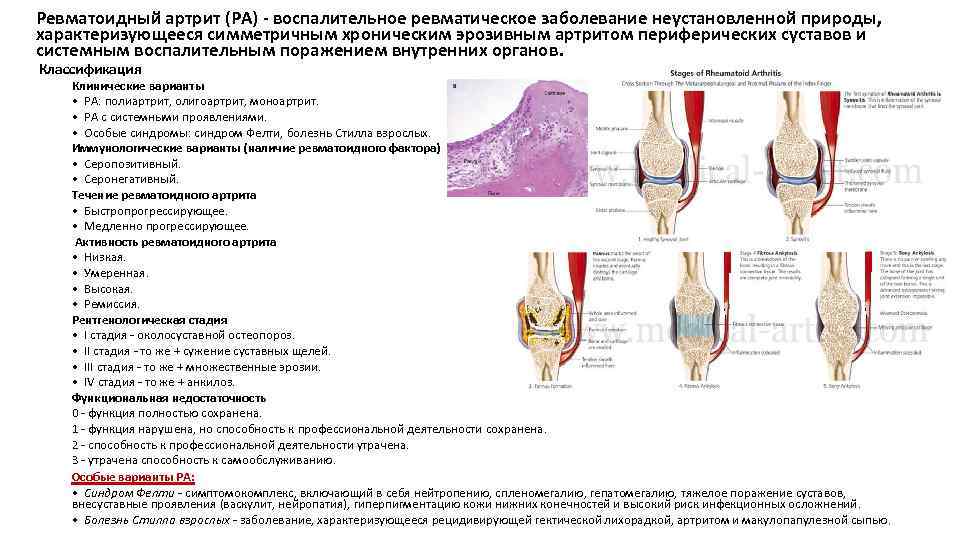 Ревматоидный артрит (РА) - воспалительное ревматическое заболевание неустановленной природы, характеризующееся симметричным хроническим эрозивным артритом