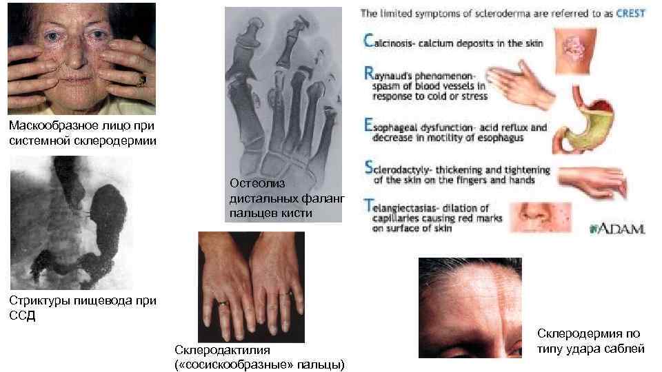 Маскообразное лицо при системной склеродермии Остеолиз дистальных фаланг пальцев кисти Стриктуры пищевода при ССД