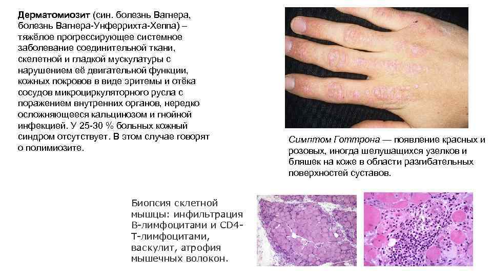 Дерматомиозит (син. болезнь Вагнера, болезнь Вагнера-Унферрихта-Хеппа) – тяжёлое прогрессирующее системное заболевание соединительной ткани, скелетной