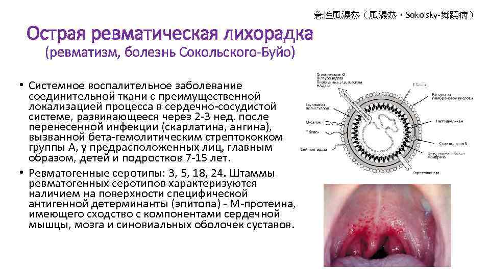 急性風濕熱（風濕熱，Sokolsky-舞踴病） Острая ревматическая лихорадка (ревматизм, болезнь Сокольского-Буйо) • Системное воспалительное заболевание соединительной ткани с