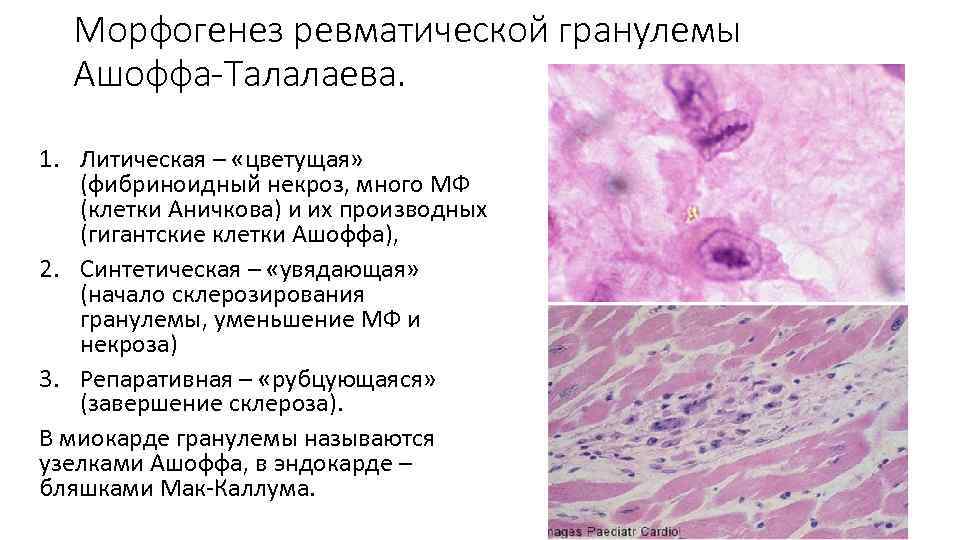 Морфогенез ревматической гранулемы Ашоффа-Талалаева. 1. Литическая – «цветущая» (фибриноидный некроз, много МФ (клетки Аничкова)