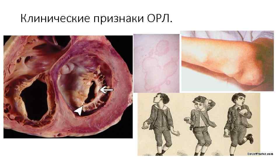 Клинические признаки ОРЛ. 