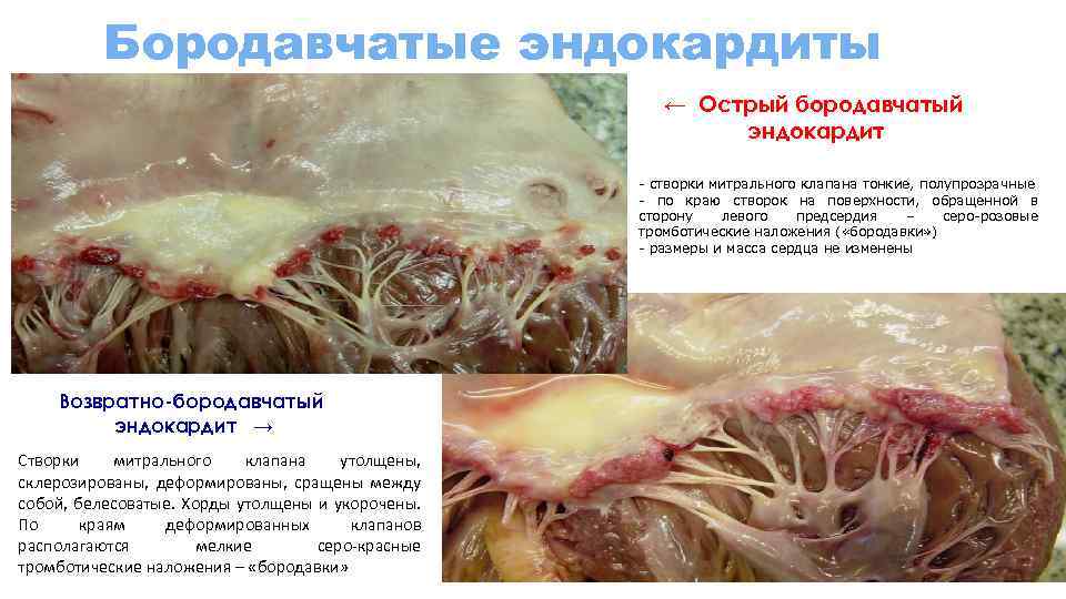 Бородавчатые эндокардиты ← Острый бородавчатый эндокардит - створки митрального клапана тонкие, полупрозрачные - по