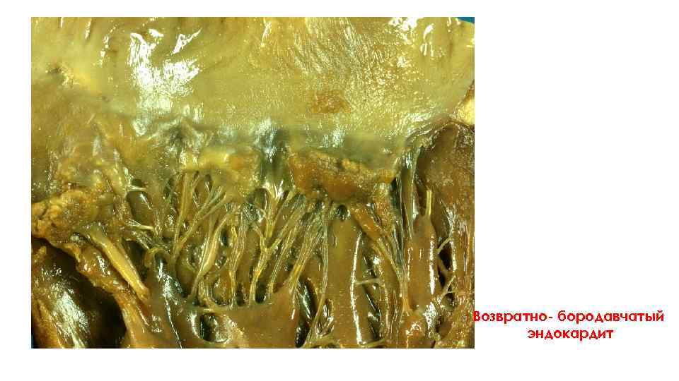 Возвратно- бородавчатый эндокардит 