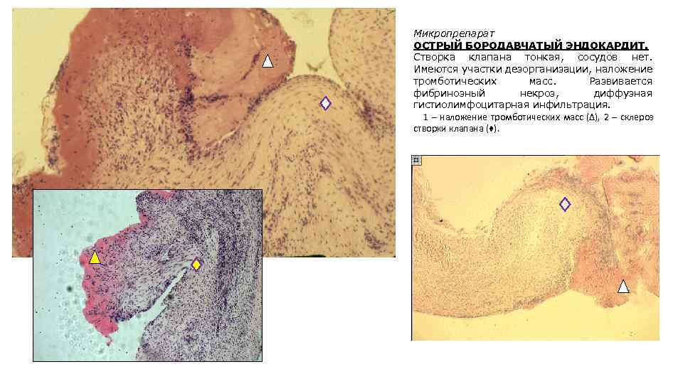Микропрепарат ОСТРЫЙ БОРОДАВЧАТЫЙ ЭНДОКАРДИТ. Створка клапана тонкая, сосудов нет. Имеются участки дезорганизации, наложение тромботических