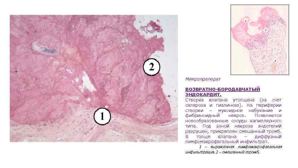 Микропрепарат ВОЗВРАТНО-БОРОДАВЧАТЫЙ ЭНДОКАРДИТ. Створка клапана утолщена (за счет склероза и гиалиноза). На периферии створки