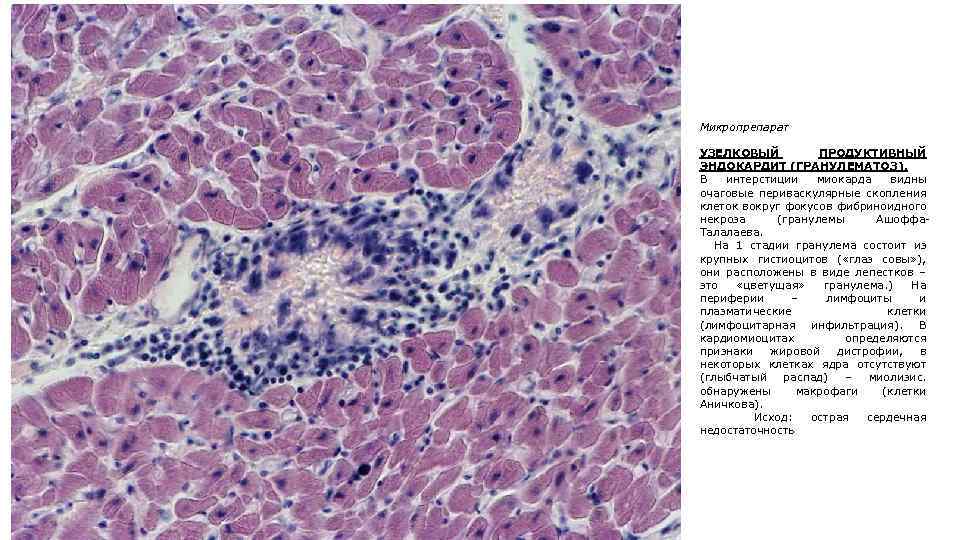 Микропрепарат УЗЕЛКОВЫЙ ПРОДУКТИВНЫЙ ЭНДОКАРДИТ (ГРАНУЛЕМАТОЗ). В интерстиции миокарда видны очаговые периваскулярные скопления клеток вокруг