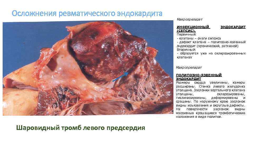 Осложнения ревматического эндокардита Макропрепарат ИНФЕКЦИОННЫЙ ЭНДОКАРДИТ (СЕПСИС). Первичный: - клапаны – очаги сепсиса -