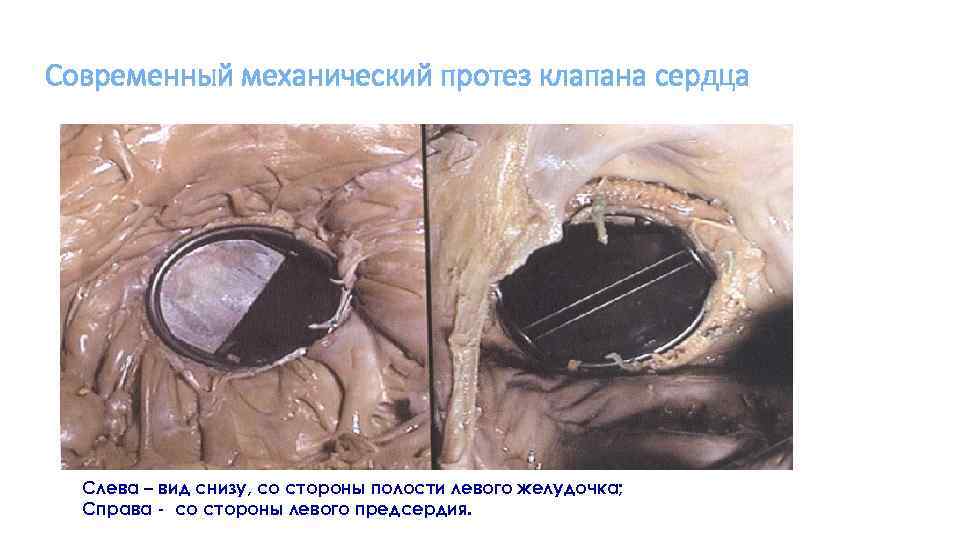 Современный механический протез клапана сердца Слева – вид снизу, со стороны полости левого желудочка;