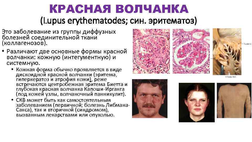 КРАСНАЯ ВОЛЧАНКА (Lupus erythematodes; син. эритематоз) Это заболевание из группы диффузных болезней соединительной ткани