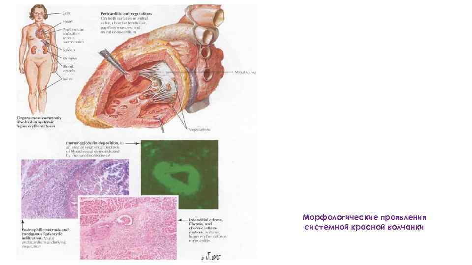 Морфологические проявления системной красной волчанки 
