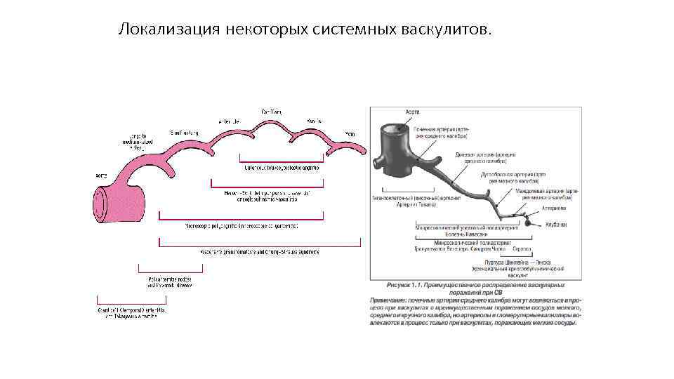 Локализация некоторых системных васкулитов. 