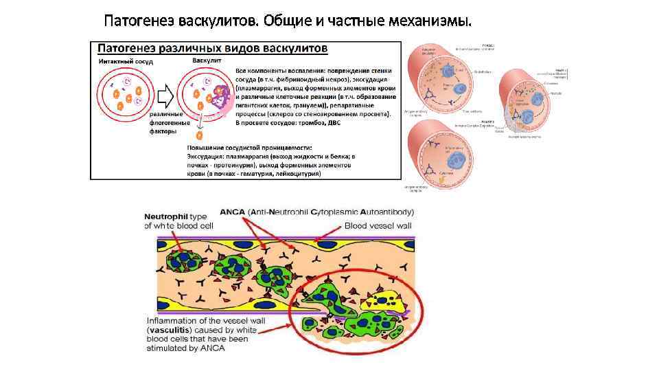 Патогенез васкулитов. Общие и частные механизмы. 