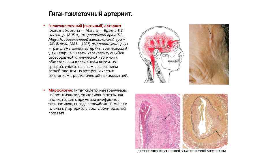 Гигантоклеточный артериит. • Гигантоклеточный (височный) артериит (болезнь Хортона — Магата — Брауна В. Т.