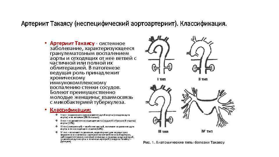 Артериит Такаясу (неспецифический аортоартериит). Классификация. • Артериит Такаясу - системное заболевание, характеризующееся гранулематозным воспалением