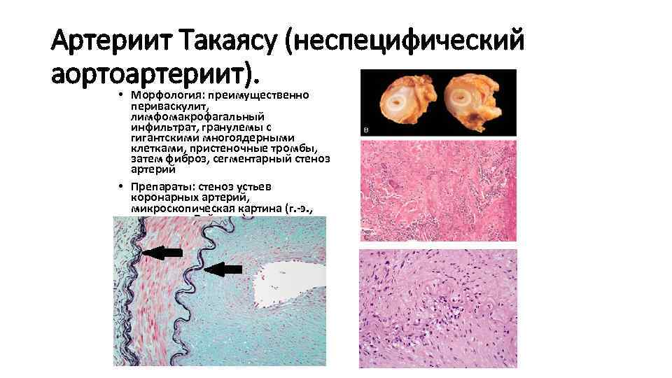 Артериит Такаясу (неспецифический аортоартериит). • Морфология: преимущественно периваскулит, лимфомакрофагальный инфильтрат, гранулемы с гигантскими многоядерными